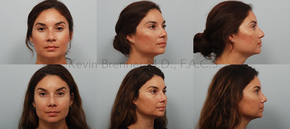 Rhinoplasty Before & After Gallery - Patient 96930134 - Image 1