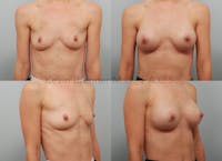 Breast Augmentation Before & After Gallery - Patient 99682501 - Image 1