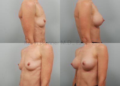 Breast Augmentation Before & After Gallery - Patient 99682501 - Image 2