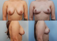 Breast Implant Removal Before & After Gallery - Patient 99683068 - Image 1