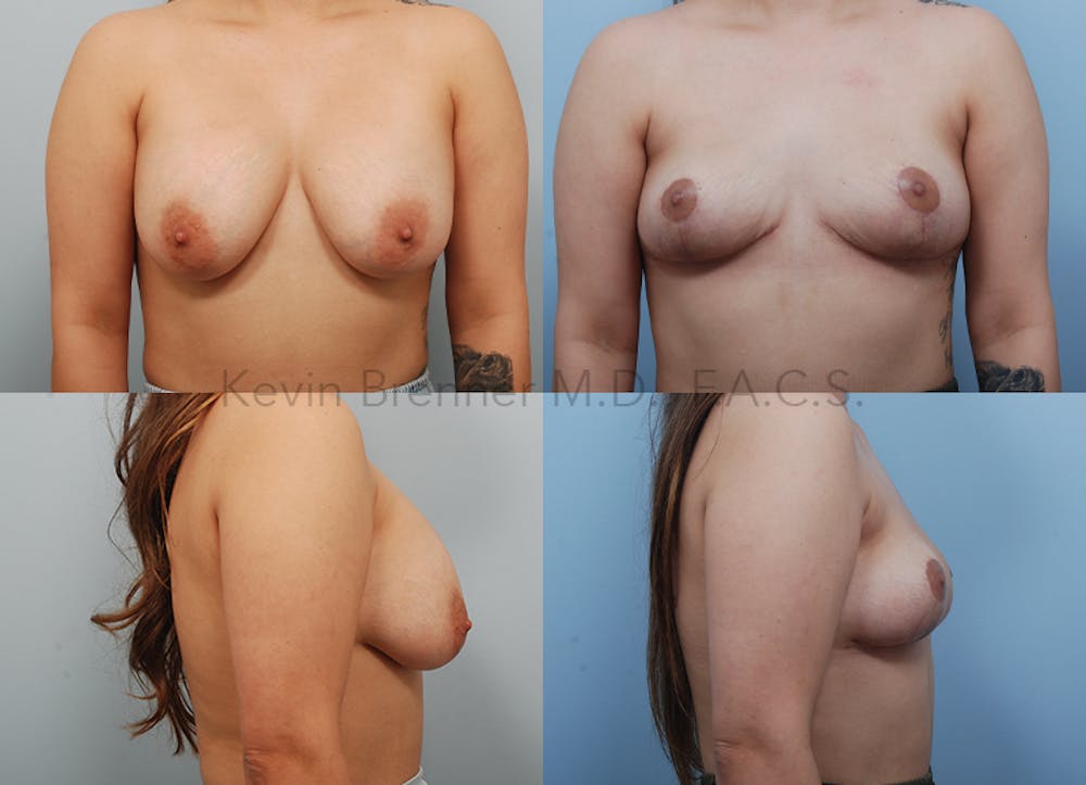 Breast Lift Before & After Gallery - Patient 257755 - Image 1