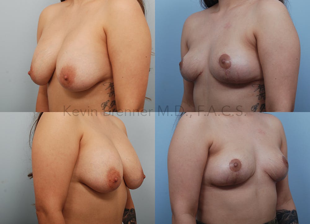 Breast Lift Before & After Gallery - Patient 257755 - Image 2
