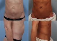 Umbilical Hernia Repair Before & After Gallery - Patient 115031708 - Image 1