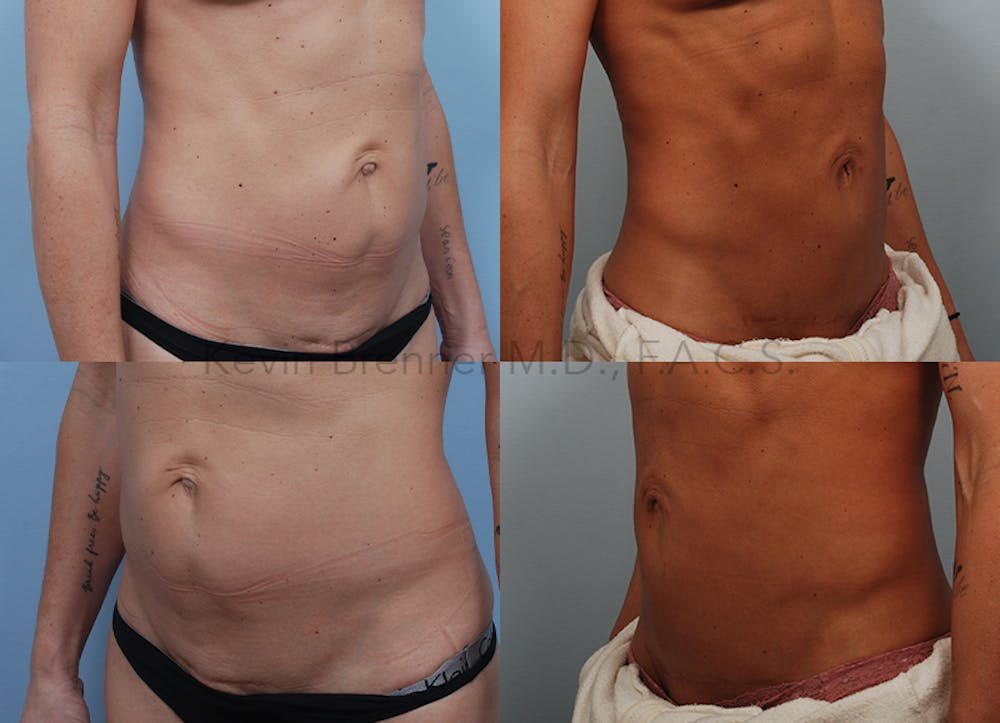 Umbilical Hernia Repair Before & After Gallery - Patient 115031708 - Image 2