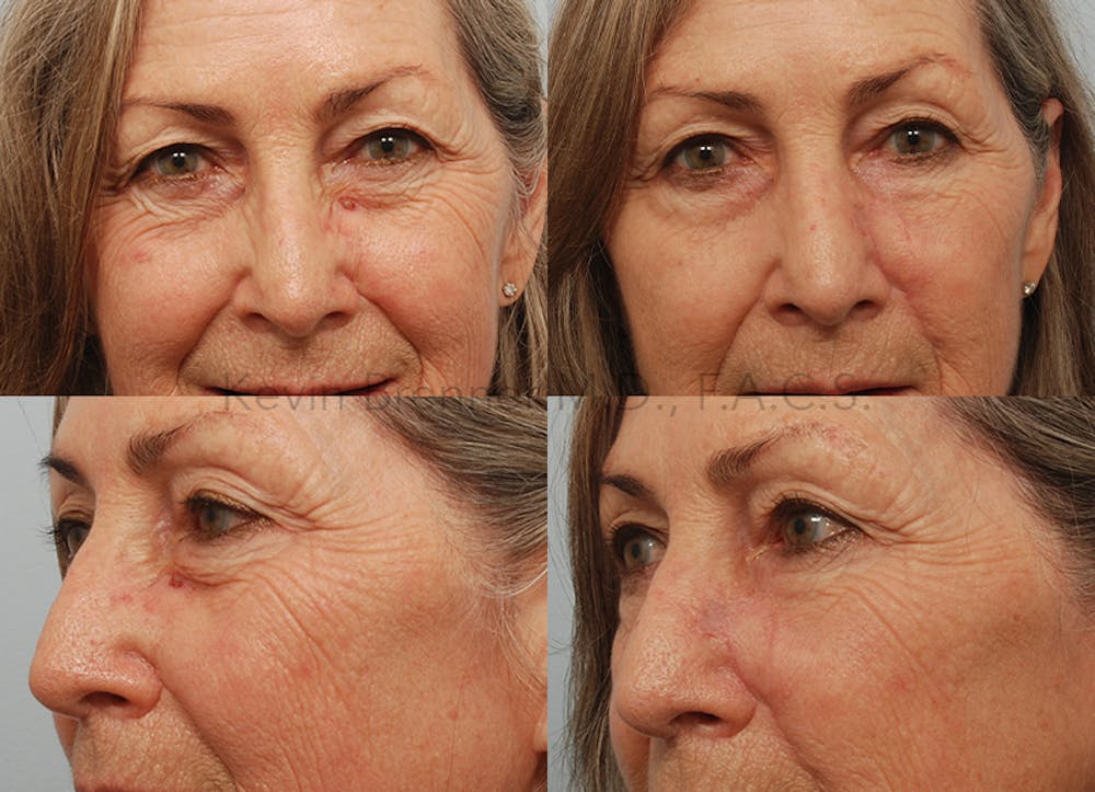 Skin Cancer Reconstruction Before & After Gallery - Patient 122269853 - Image 1