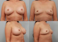 Breast Implant Removal without Lift Before & After Gallery - Patient 994201 - Image 1
