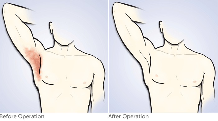before and after example armpit