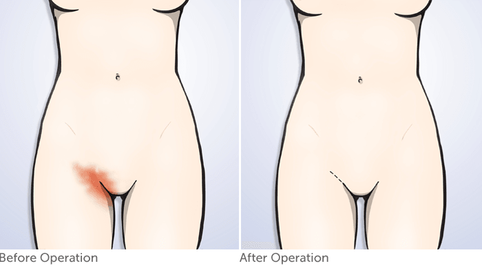 before and after example groin