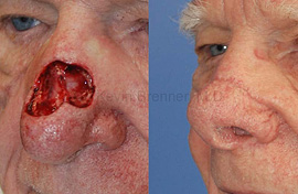 before and after of facial skin reconstruction