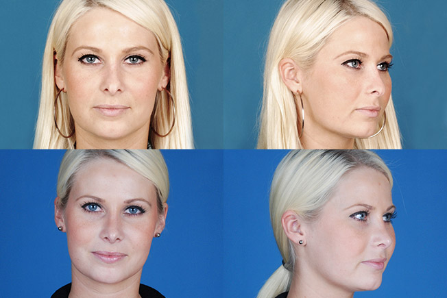 before and after of revision rhinoplasty patient