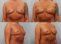 Fat Transfer Post Explant Before & After Gallery - Patient 123816500 - Image 1