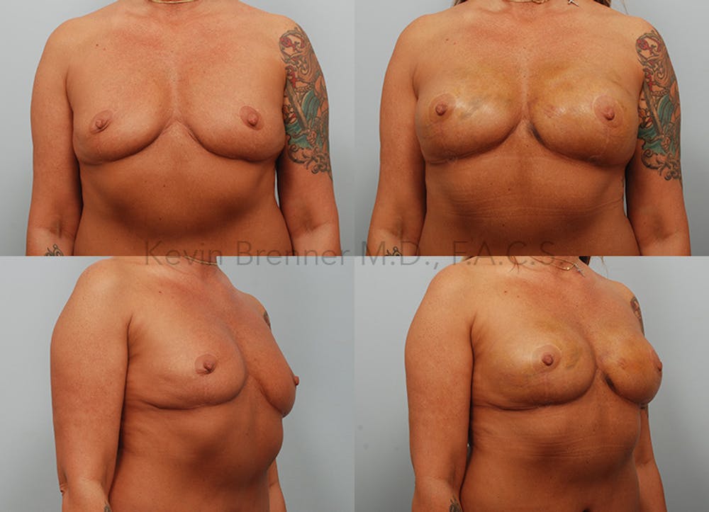 Fat Transfer Post Explant Before & After Gallery - Patient 123816500 - Image 1