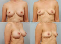 Breast Implant Removal Before & After Gallery - Patient 123815217 - Image 1