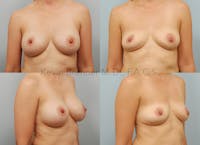 Breast Implant Removal without Lift Before & After Gallery - Patient 145042 - Image 1