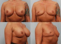 Breast Lift Before & After Gallery - Patient 350892 - Image 1