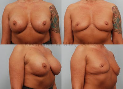 Breast Lift Before & After Gallery - Patient 350892 - Image 1