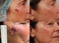 Skin Cancer Reconstruction Before & After Gallery - Patient 123859752 - Image 1