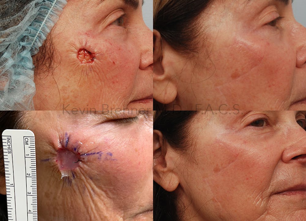 Skin Cancer Reconstruction Gallery - Patient 123859752 - Image 1