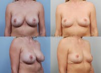 Breast Implant Removal Before & After Gallery - Patient 123886901 - Image 1