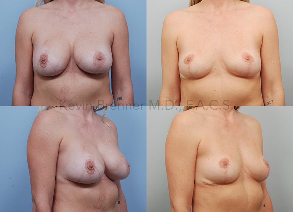 Breast Lift Before & After Gallery - Patient 216538 - Image 1