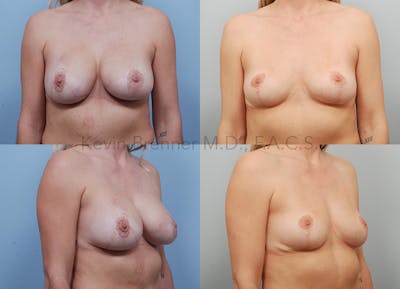 Breast Implant Removal Before & After Gallery - Patient 123886901 - Image 1
