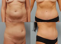 Tummy Tuck Before & After Gallery - Patient 131467733 - Image 1