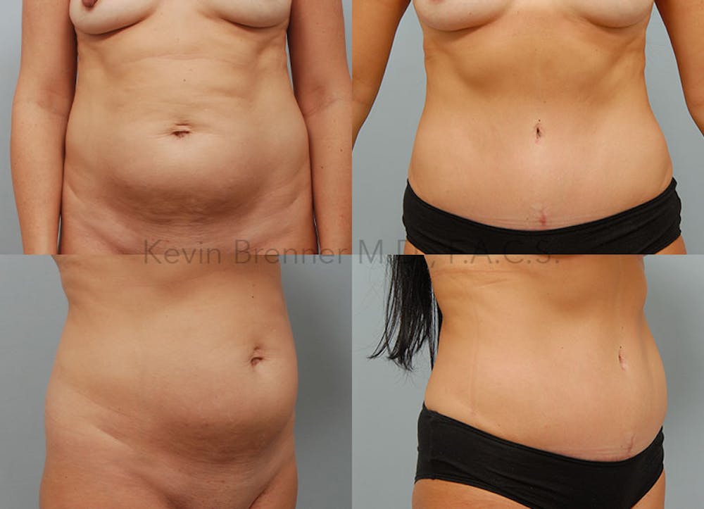 Tummy Tuck Before & After Gallery - Patient 131467733 - Image 1