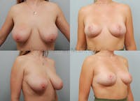 Breast Lift Before & After Gallery - Patient 131684688 - Image 1