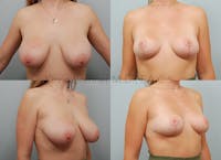 Breast Reduction Before & After Gallery - Patient 263261 - Image 1