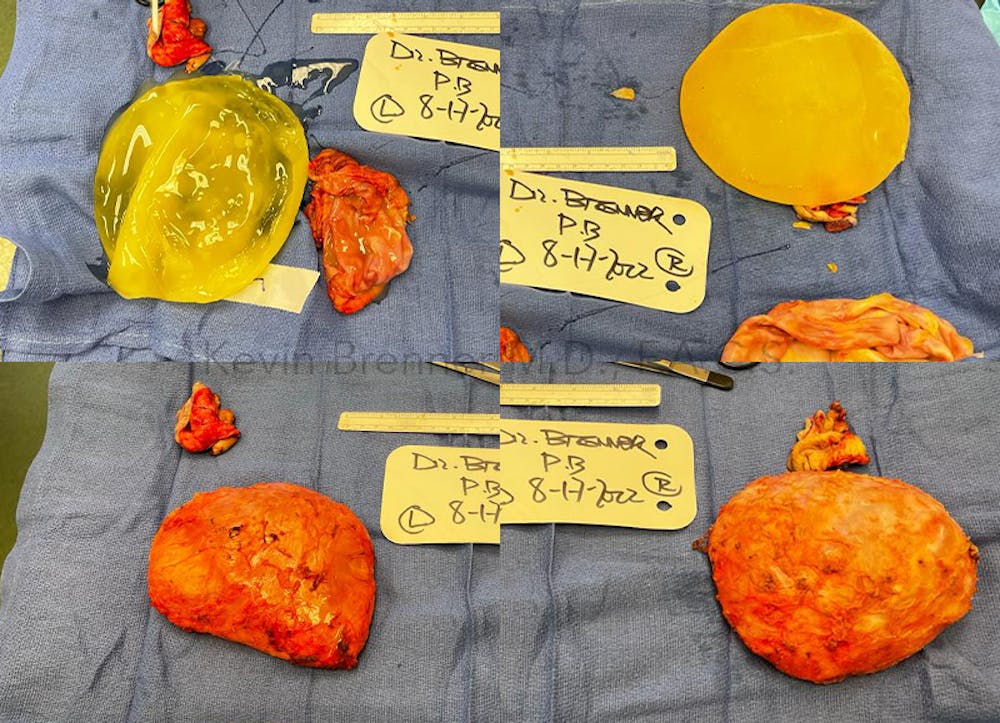 Breast Capsules Before & After Gallery - Patient 132706002 - Image 1