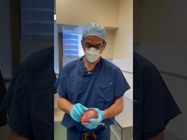 Case of the Day: Explant and Full Breast Lift <span class='block'>Take a look as Dr. Brenner examines implants he took out of a patient. This patient came in after experiencing some BII symptoms but mainly due to the size of her implants.