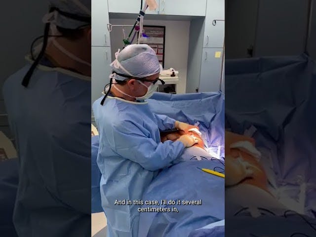 In The OR: Incisions During Breast Lift & Explant <span class='block'>Watch along as Dr. Kevin Brenner talks about how he creates incisions during a breast lift and capsulectomy.
