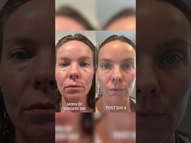 Patients Before and After Explant Procedures <span class='block'>Check out these before and afters of patients and their change in inflammation after getting their breast implants taken out!
