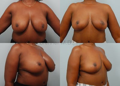 Breast Lift Before & After Gallery - Patient 494144 - Image 1