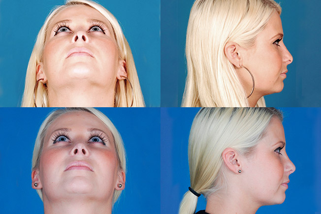 before and after of a patient after revisionary rhinoplasty in Beverly Hills
