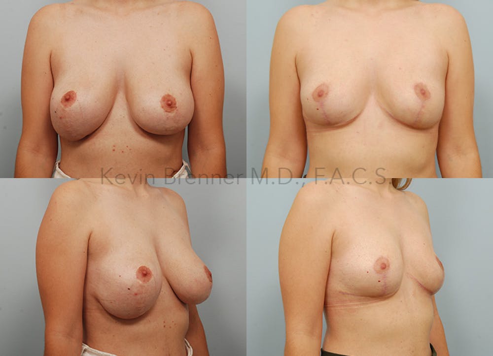 Breast Lift Before & After Gallery - Patient 146150539 - Image 1