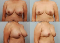 Breast Lift Before & After Gallery - Patient 146150554 - Image 1