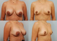 Breast Lift Before & After Gallery - Patient 146150560 - Image 1
