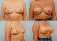 Breast Lift Before & After Gallery - Patient 146209641 - Image 1