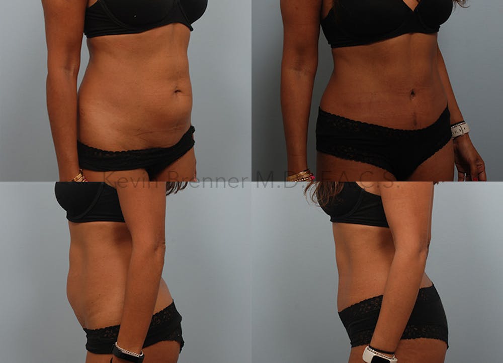 Tummy Tuck Before & After Gallery - Patient 146343701 - Image 1