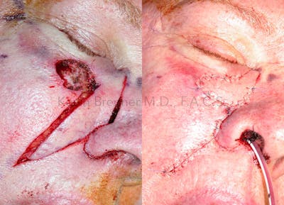 Skin Cancer Reconstruction Before & After Gallery - Patient 146362265 - Image 2