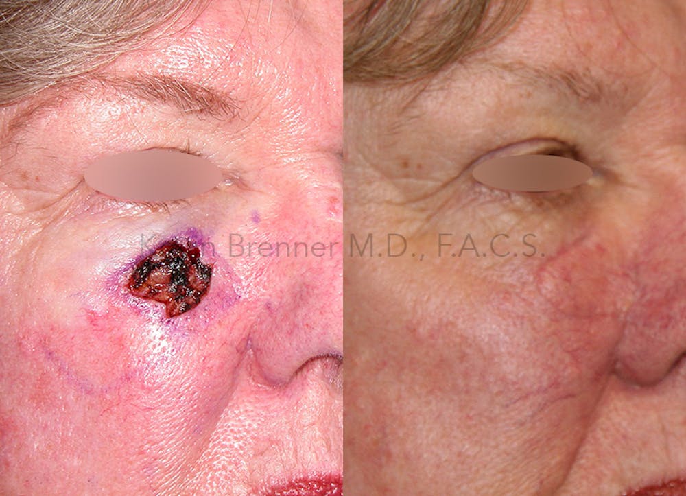 Skin Cancer Reconstruction Before & After Gallery - Patient 146362265 - Image 1