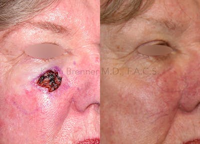 Skin Cancer Reconstruction Before & After Gallery - Patient 146362265 - Image 1