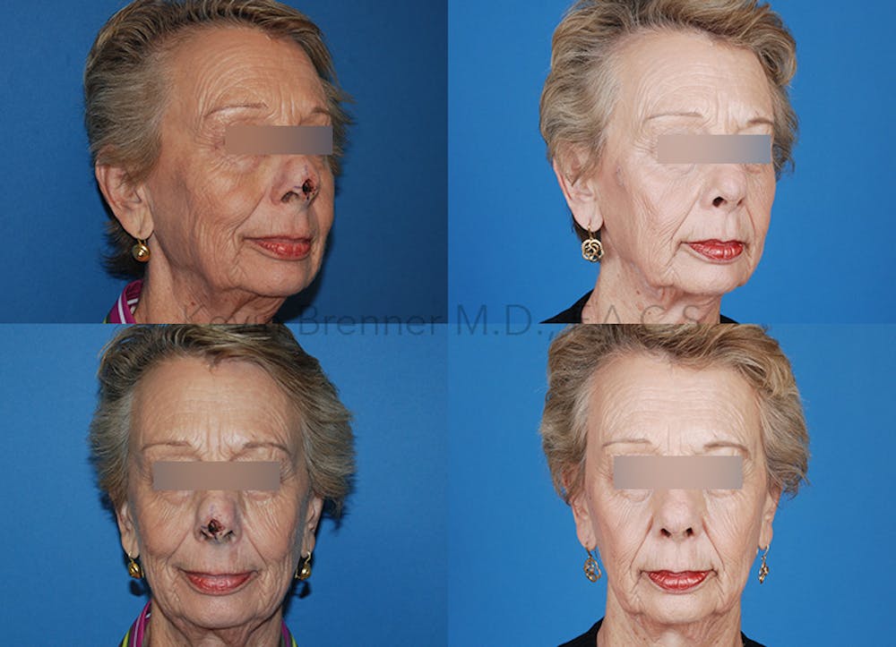 Rhinoplasty Before & After Gallery - Patient 146649472 - Image 1