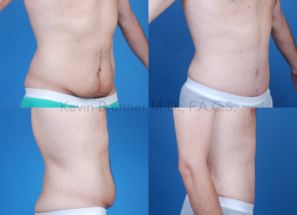 Tummy Tuck Before & After Gallery - Patient 146649498 - Image 1