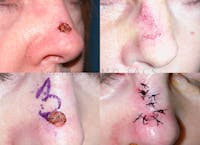 Skin Cancer Reconstruction Before & After Gallery - Patient 146649571 - Image 1