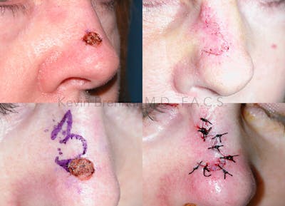 Skin Cancer Reconstruction Before & After Gallery - Patient 146649571 - Image 1