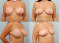Breast Implant Removal Before & After Gallery - Patient 146866127 - Image 1