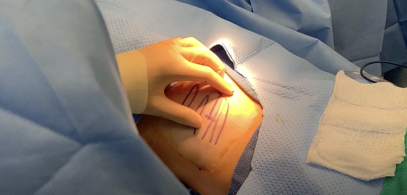 Rib Graft for Rhinoplasty Part 2