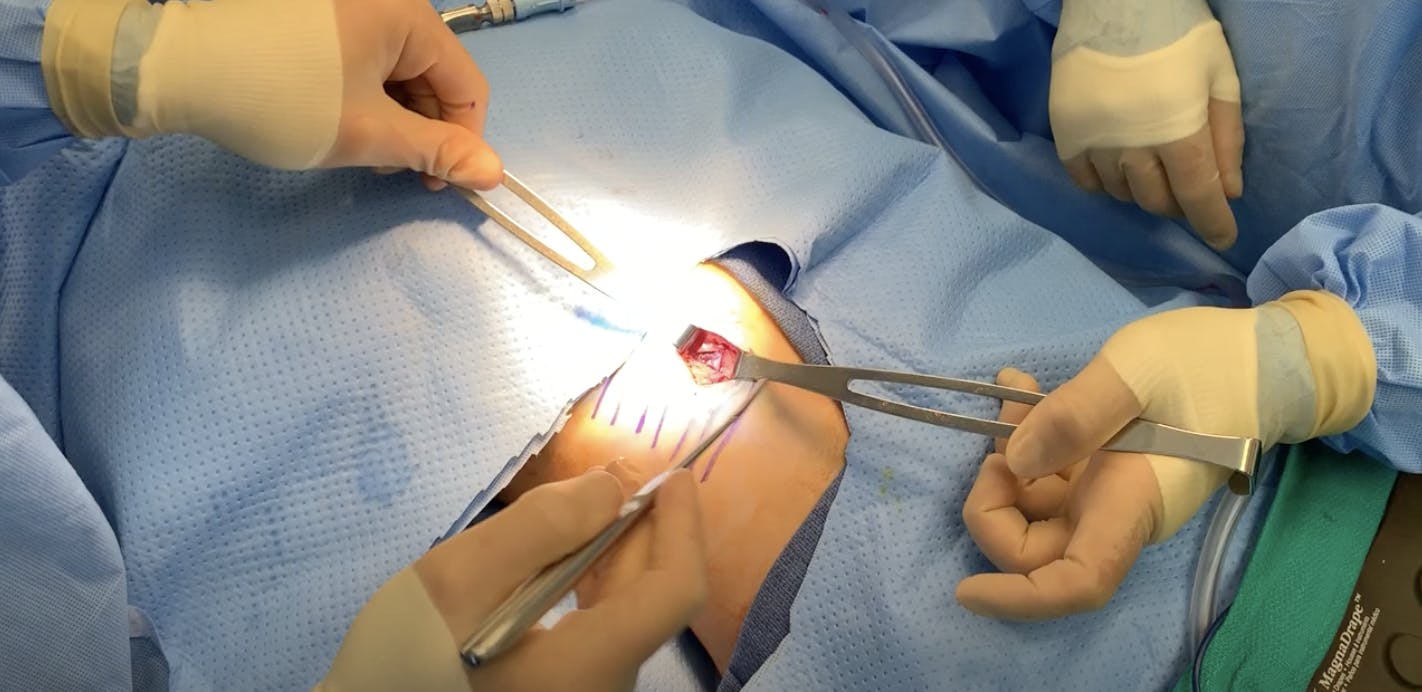 Rib Graft for Rhinoplasty Part 3
